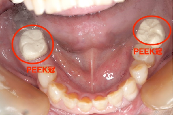 愛媛県松山市の歯医者もりもと歯科クリニック｜ブログ｜奥歯も保険適用で白い歯に！PKKE冠とは？CAD/CAM冠との違いも解説｜PEEK冠による症例の口腔画像