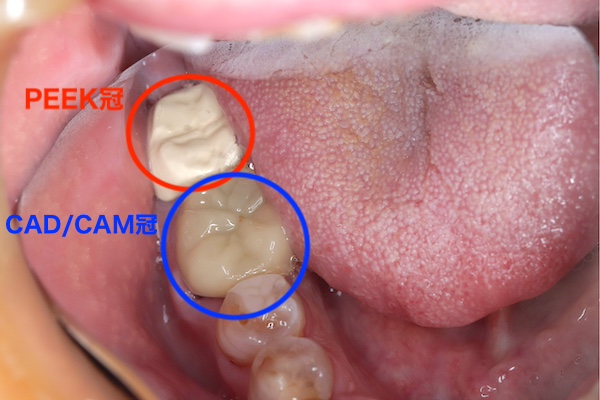 愛媛県松山市の歯医者もりもと歯科クリニック｜ブログ｜奥歯も保険適用で白い歯に！PEEK冠とは？CAD/CAM冠との違いも解説｜PEEK冠による症例の口腔画像
