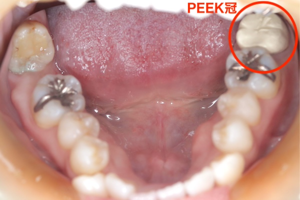 愛媛県松山市の歯医者もりもと歯科クリニック｜ブログ｜奥歯も保険適用で白い歯に！PKKE冠とは？CAD/CAM冠との違いも解説｜PEEK冠による症例の口腔画像