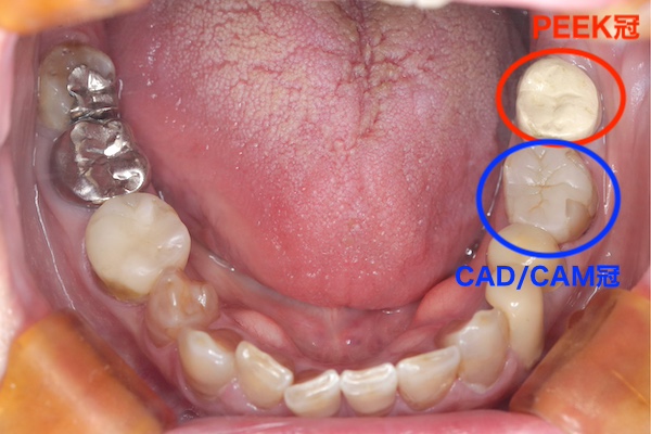 愛媛県松山市の歯医者もりもと歯科クリニック｜ブログ｜奥歯も保険適用で白い歯に！PEEK冠とは？CAD/CAM冠との違いも解説｜PEEK冠による症例の口腔画像