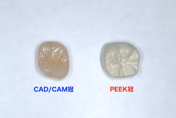 愛媛県松山市の歯医者もりもと歯科クリニック｜ブログ｜奥歯も保険適用で白い歯に！PKKE冠とは？CAD/CAM冠との違いも解説｜PEEK冠による症例の口腔画像
