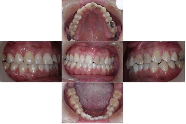 松山 もりもと歯科｜ブログ｜【症例】保険診療で行なったメタルフリー治療｜治療前の歯の画像